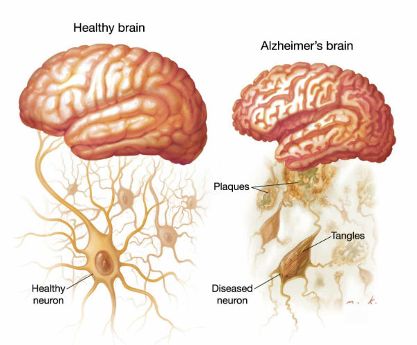 Alzheimers Disease Veledora Health