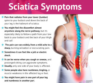 High Effective Sciatica Exercises for Reducing Pain! - Veledora health