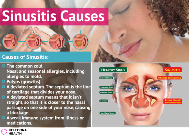 Sinusitis And Allergy Treatment And Natural Remedies!