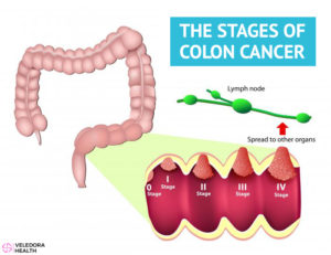 Colon Cancer Causes, Symptoms And Treatment! - Veledora health
