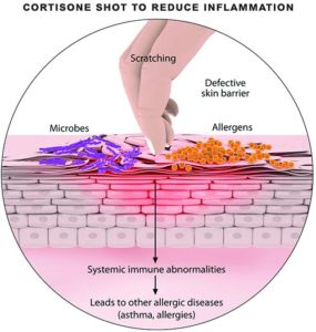 Eczema, Identifying Causes And Eczema Triggers! - Veledora health