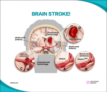 Transient Ischemic Attack (TIA) Warning Signs of Stroke! - Veledora health