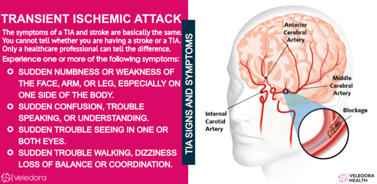 Transient Ischemic Attack Tia Warning Signs Of Stroke Veledora Health