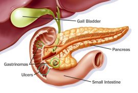 Peptic Ulcer Disease - Diet Chart For Stomach Ulcer!