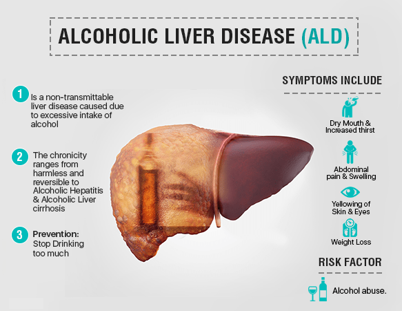 alcoholic-and-nonalcoholic-fatty-liver-disease