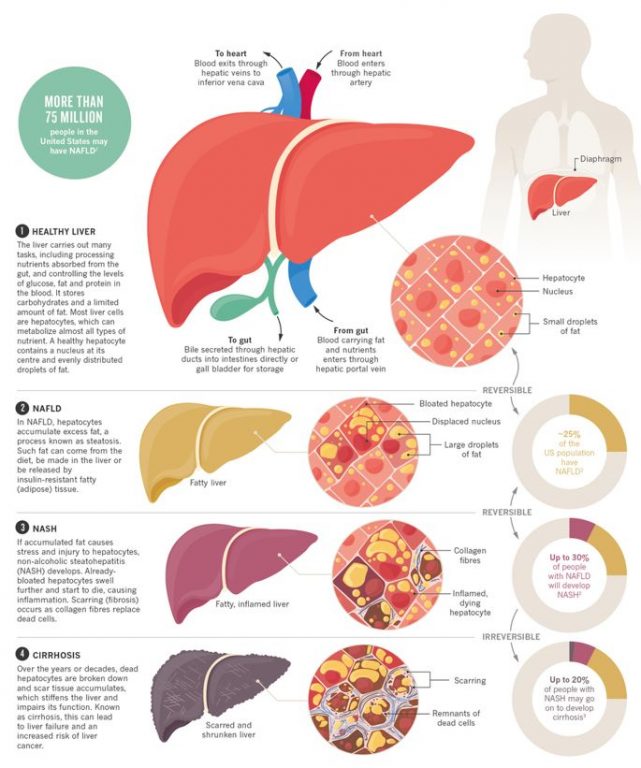 Alcoholic And Nonalcoholic Fatty Liver Disease 