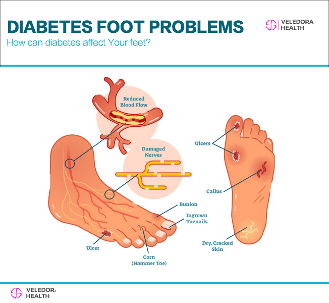 how-can-diabetes-affect-your-feet-diabetes-foot-problems