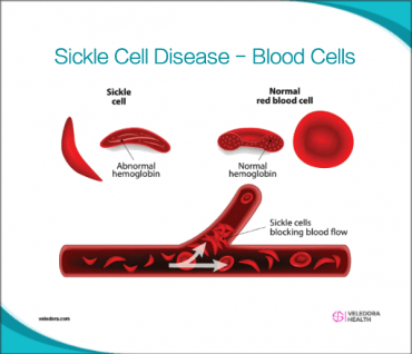 Sickle Cell Disease, How to Deal With Complications?