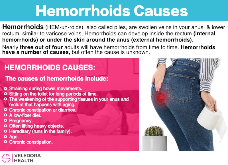 Hemorrhoids Causes Symptoms And Treatment 4853