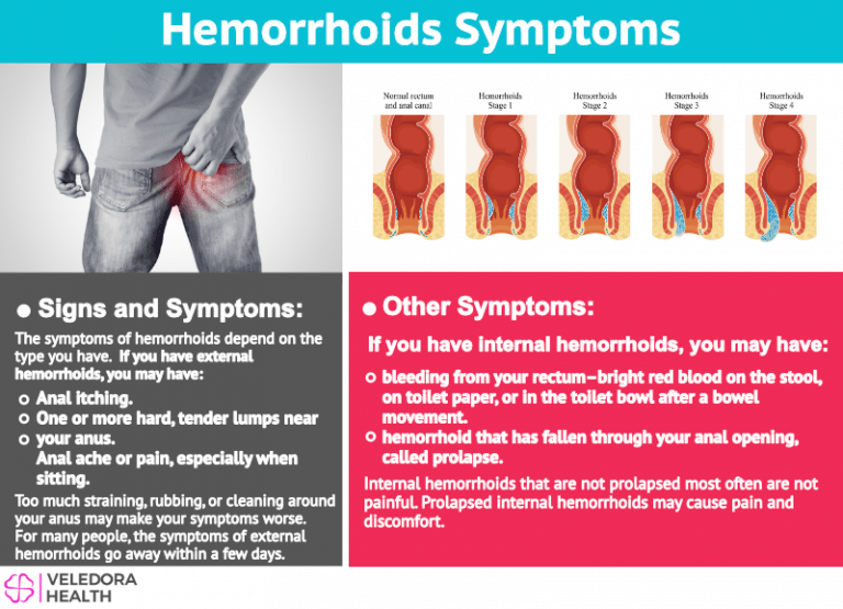 Hemorrhoids, Causes, Symptoms And Treatment!