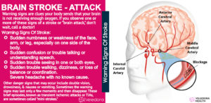 Brain Stroke, How To Prevent Brain Stroke! - Veledora Health