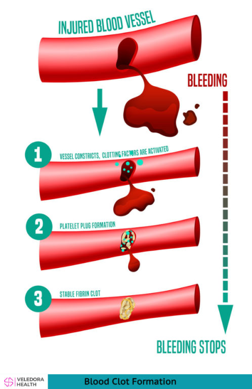 Blood Clots, Risks, Symptoms And Prevention! - Veledora health